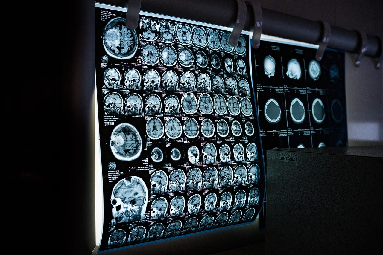 9. Neurological Enhancement (image credits: pixabay)