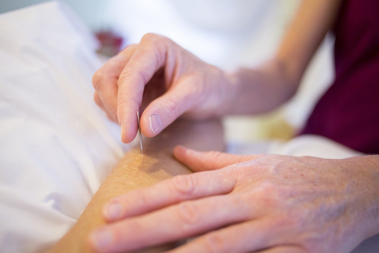 Acupuncture (image credits: pixabay)