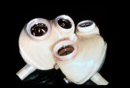 Artificial Hearts (1969 – Jarvik 7 and beyond) (image credits: wikimedia)