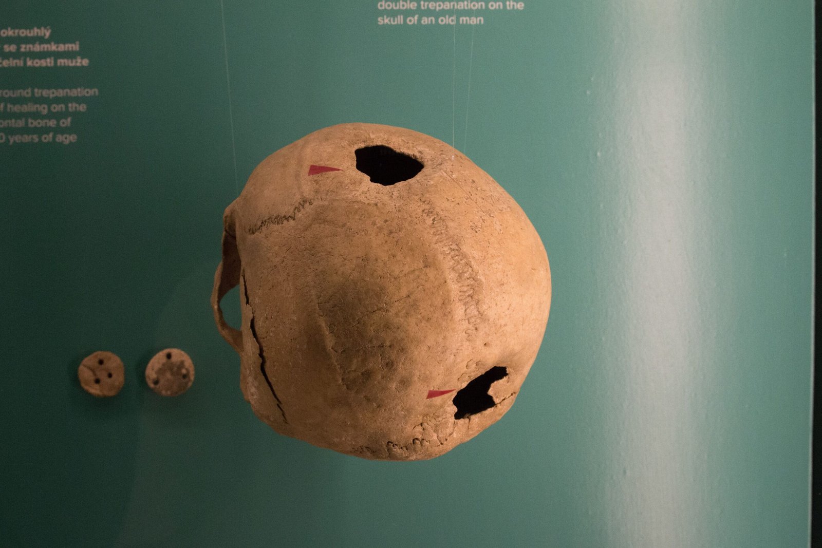 Bronze Age Cranial Surgery (Worldwide, ~3000 BCE) (image credits: wikimedia)