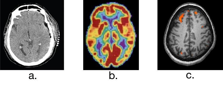 fMRI Brain Imaging - Revolutionizing Neuroscience (image credits: wikimedia)
